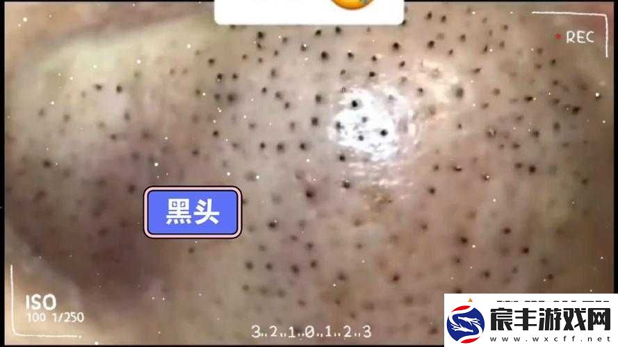 粗大黑头紫大黑头紫挤进引发的一系列奇妙现象和思考